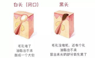 辨別黑頭與閉口，黑頭儀的正確使用與誤區